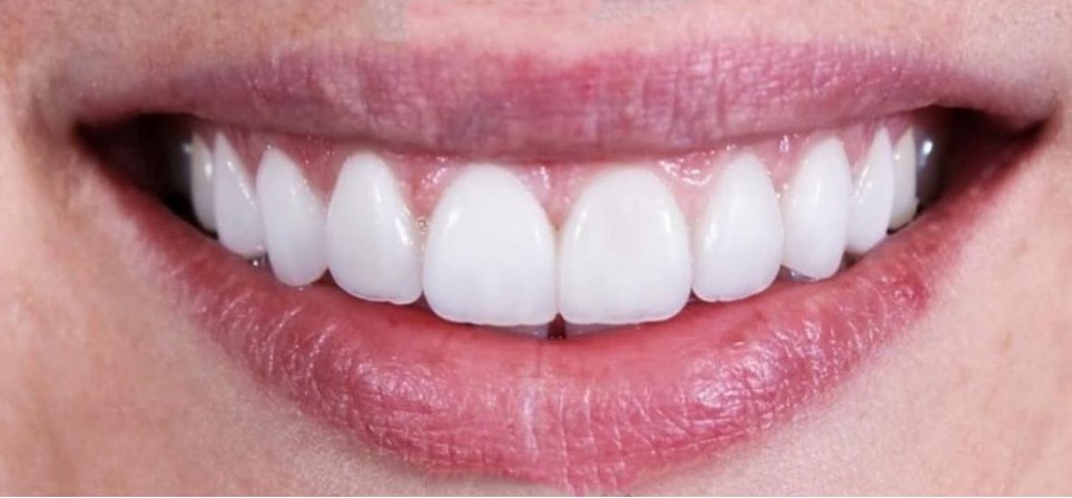 Cam Seramik Lamine Uygulaması