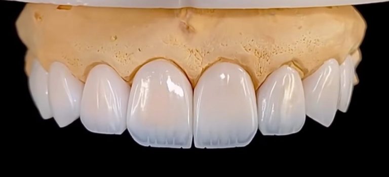 IPS e.max Cam Seramik Restorasyon