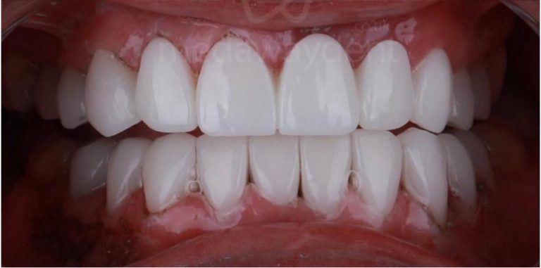 Alt ve Üst Arkta Estetik Bütünlük