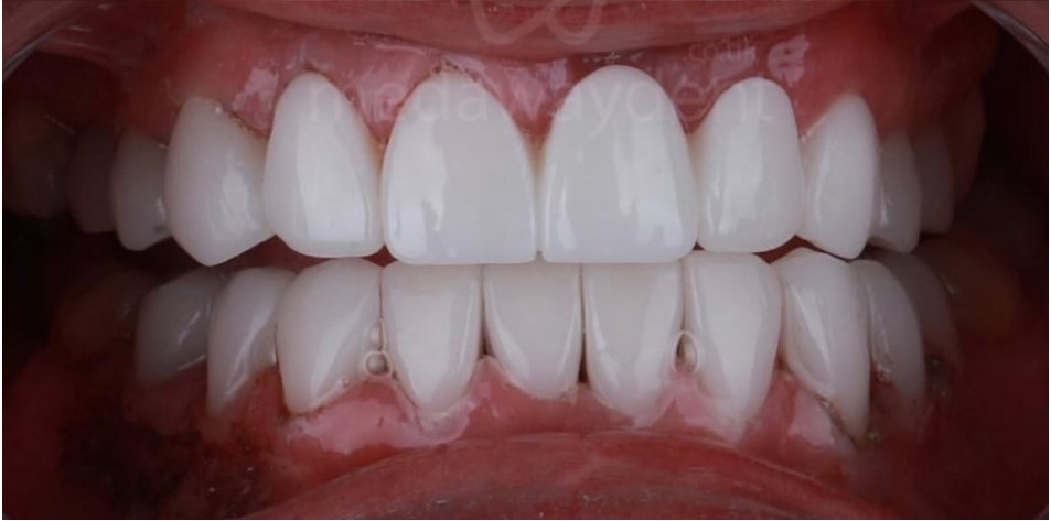 Alt ve Üst Arkta Estetik Bütünlük