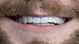 Zirkonyumun Doğal Yansıması